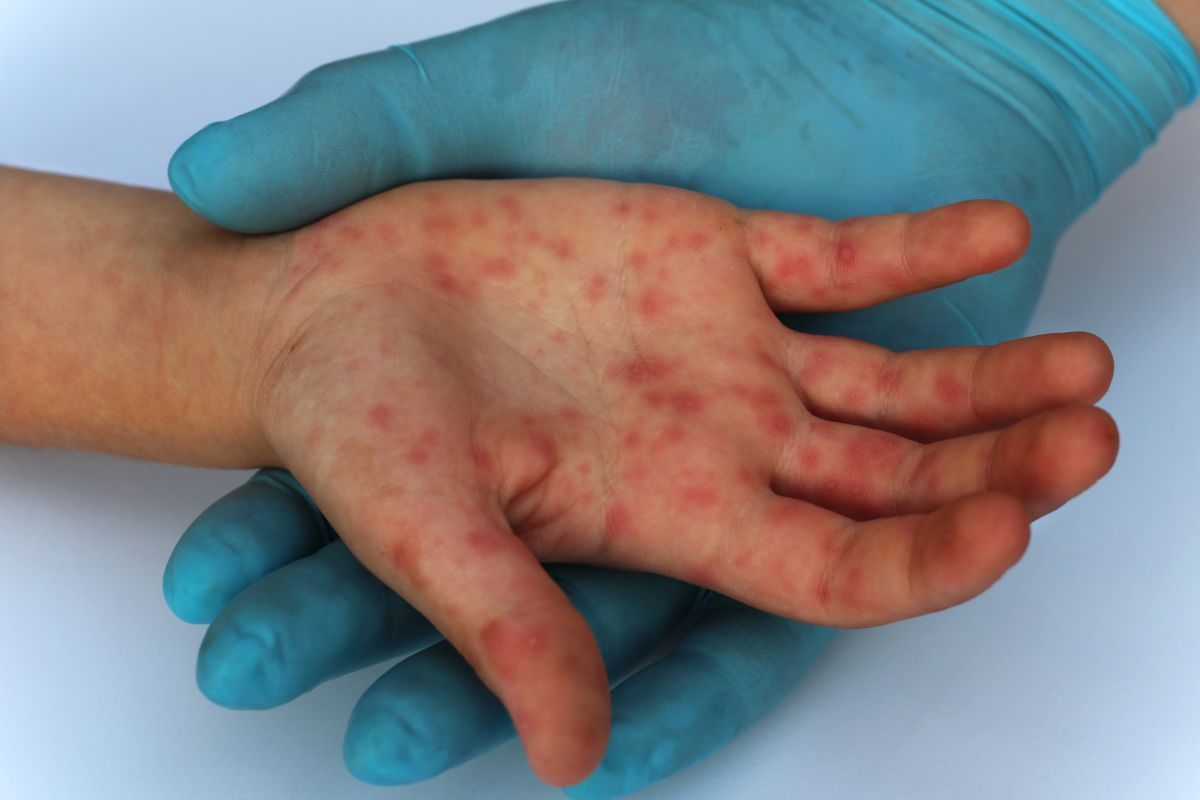 Întâlnire de urgenţă a OMS pe tema variolei maimuţei: 100 de cazuri au fost confirmate sau sunt suspectate în Europa