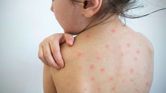 Focar de rujeolă într-o familie revenită dintr-o vacanță în Ucraina: Copilul și tatăl, infectați